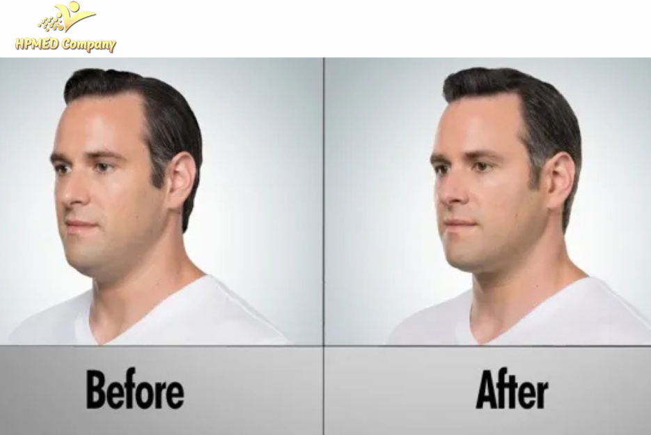 Nguyên tắc giảm mỡ mặt hiệu quả cho nam giới