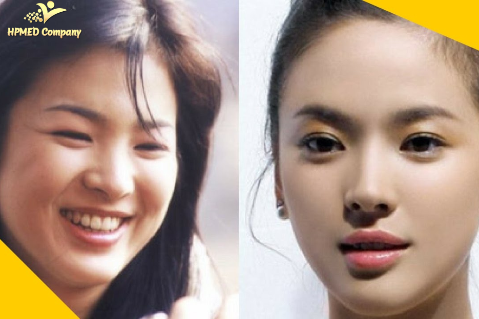 Cách giảm mỡ mặt tự nhiên hiệu quả