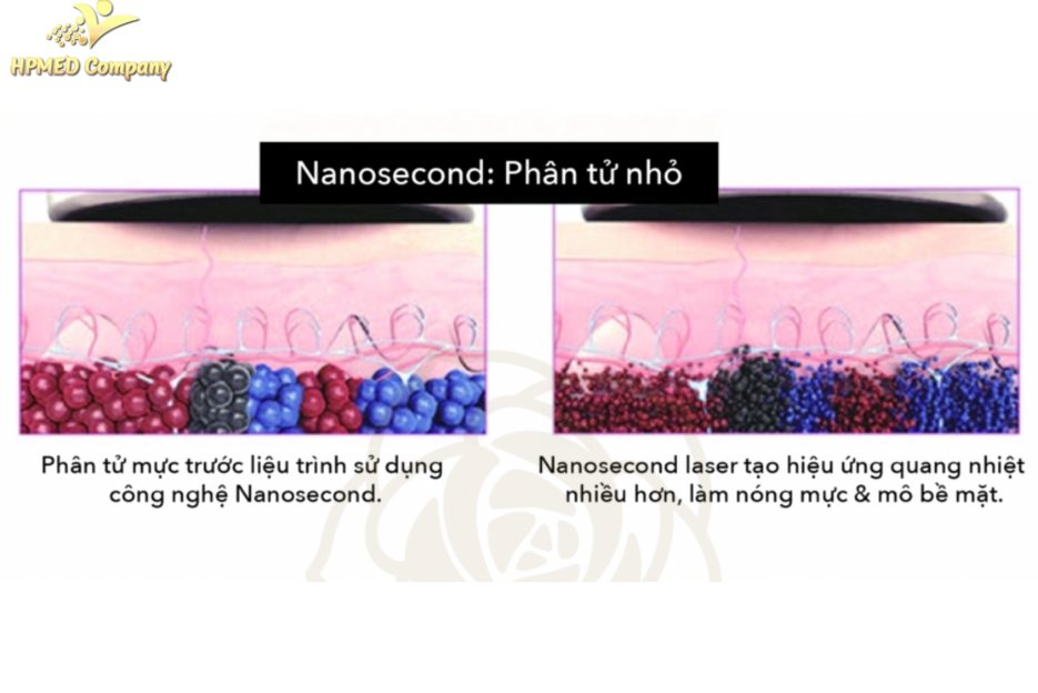 So sánh Công nghệ Laser Nanoseconds và Picoseconds 2 Laser Nanosecond (Q-Switched ND:YAG)