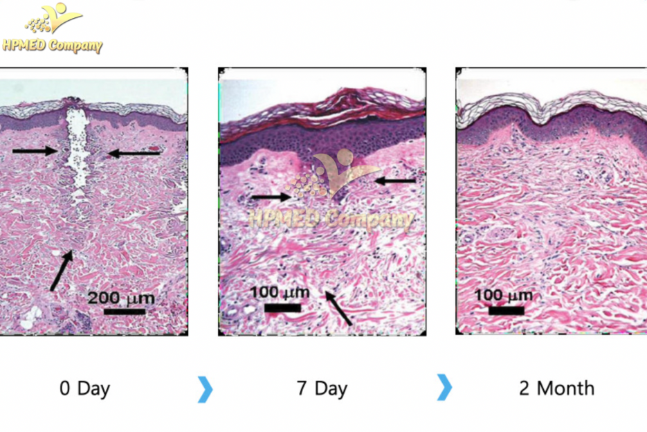 Tại sao nên triệt lông nách?