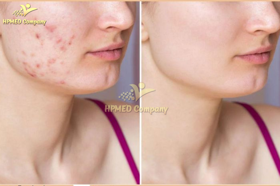 Máy xóa nhăn Công nghệ RF Máy xóa nhăn Công nghệ RF