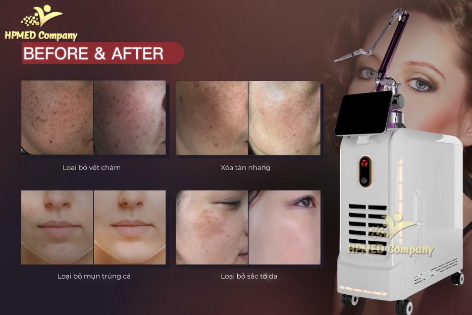 máy trẻ hóa da là gì ? 5 loại máy trẻ hóa da hiện nay 4 Công nghệ Laser