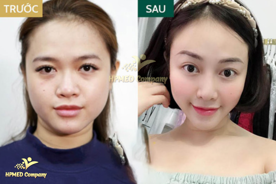 Máy Giảm Mỡ Mặt – Giải Pháp Làm Thon Gọn Khuôn Mặt Hiệu Quả 4 88