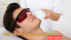 Triệt râu phương pháp nào tốt ? chi phí bao nhiêu ?