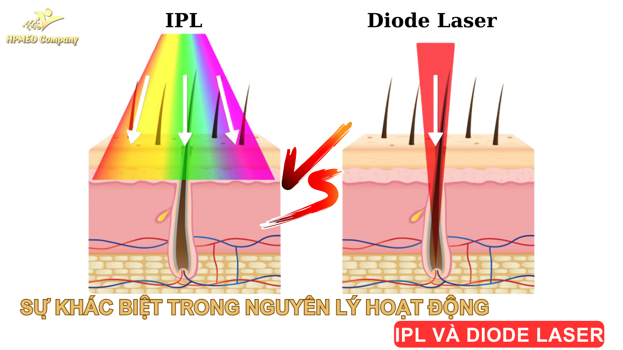 Sự Khác Biệt Trong Nguyên Lý Hoạt Động IPL và Diode Laser