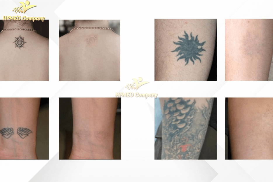 Xóa xăm bằng Laser YAG