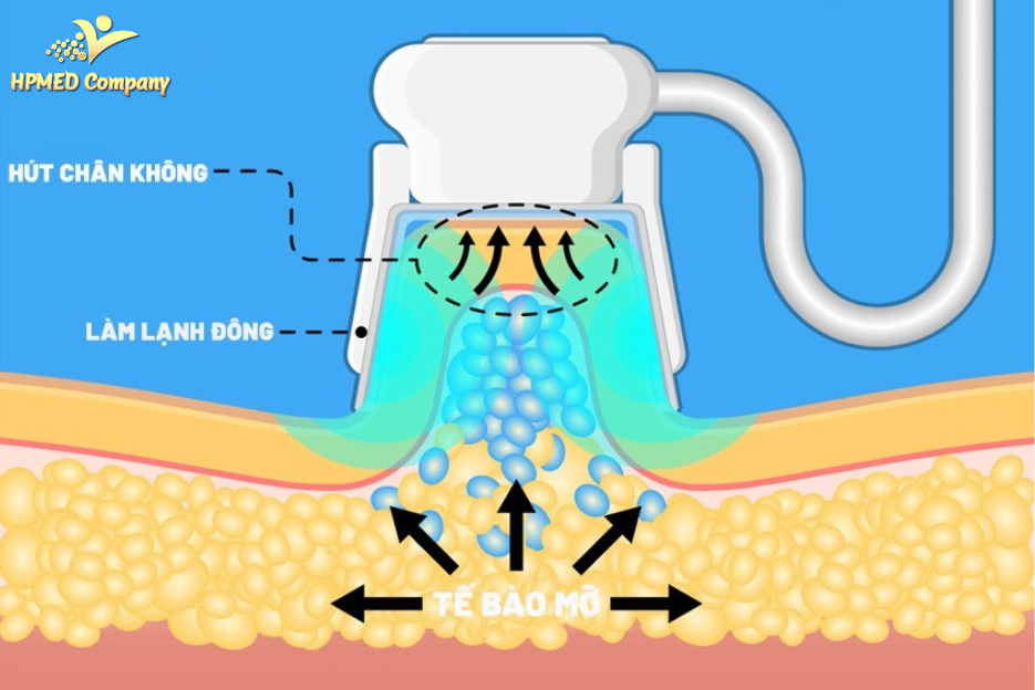 Công nghệ Cryolipolysis – Đông hủy mỡ bằng nhiệt lạnh
