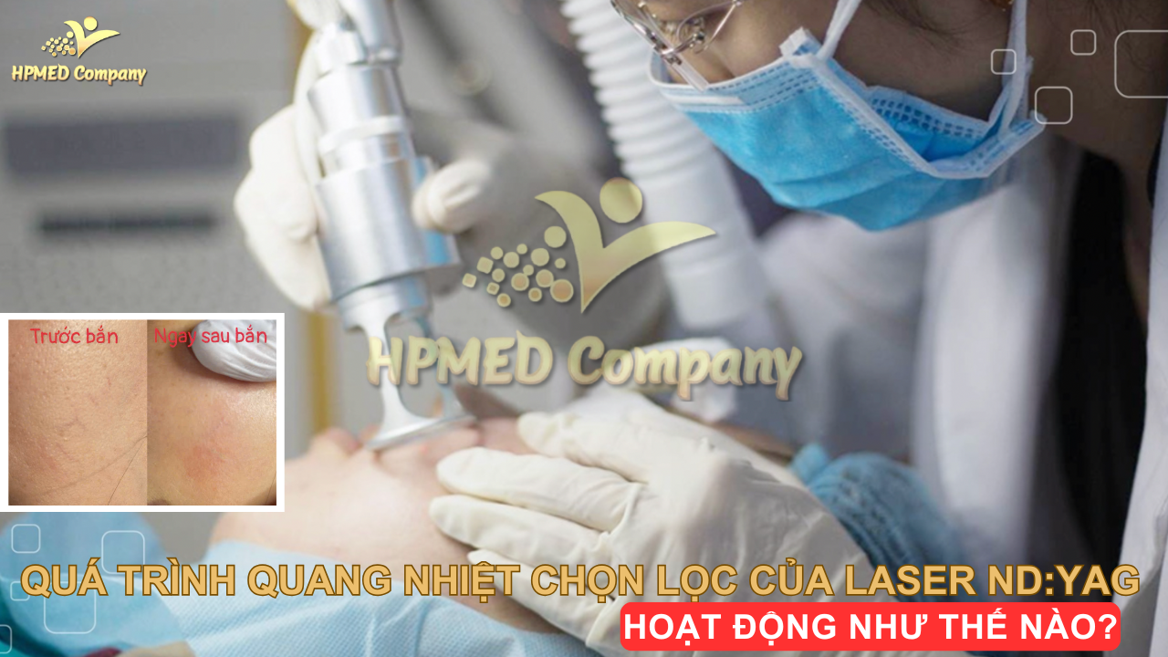 Quá trình quang nhiệt chọn lọc của laser ND:YAG hoạt động như thế nào? 1 Quá trình quang nhiệt chọn lọc của laser ND:YAG