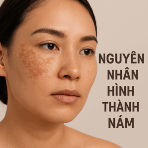 Nguyên Nhân Hình Thành Nám Và Giải Pháp Điều Trị Hiệu Quả