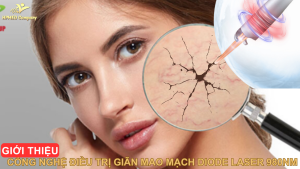 Giới Thiệu Công Nghệ Điều Trị Giãn Mao Mạch Diode Laser 980nm