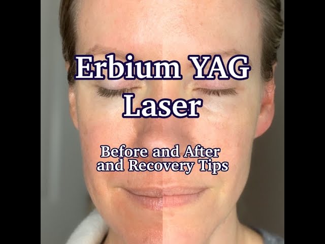 Erbium Laser là gì ? nguyên lý hoạt động và 8 ứng dụng phổ biến của Erbium Laser