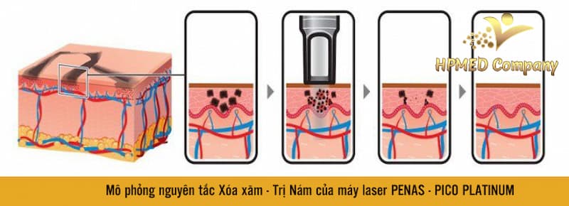 máy xoá xăm penas máy xoá xăm penas