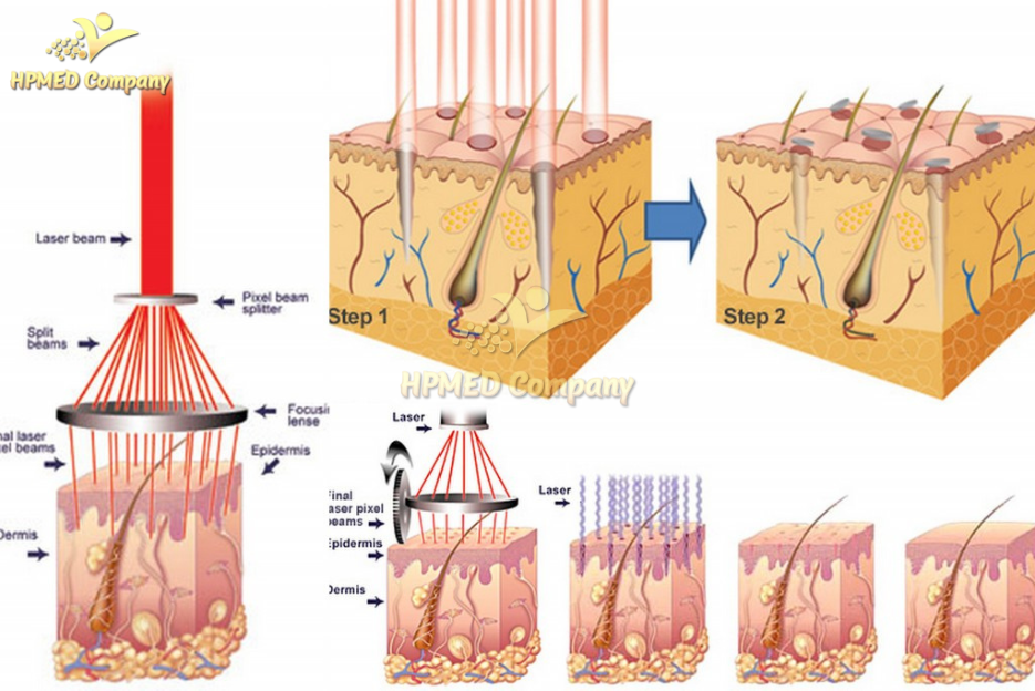 Đầu Tư Để Nhanh Thu Hồi Vốn: Nên Chọn Laser CO2 Fractional Hay Laser Nd YAG Trước? 2 Máy Laser Co2 Fractional