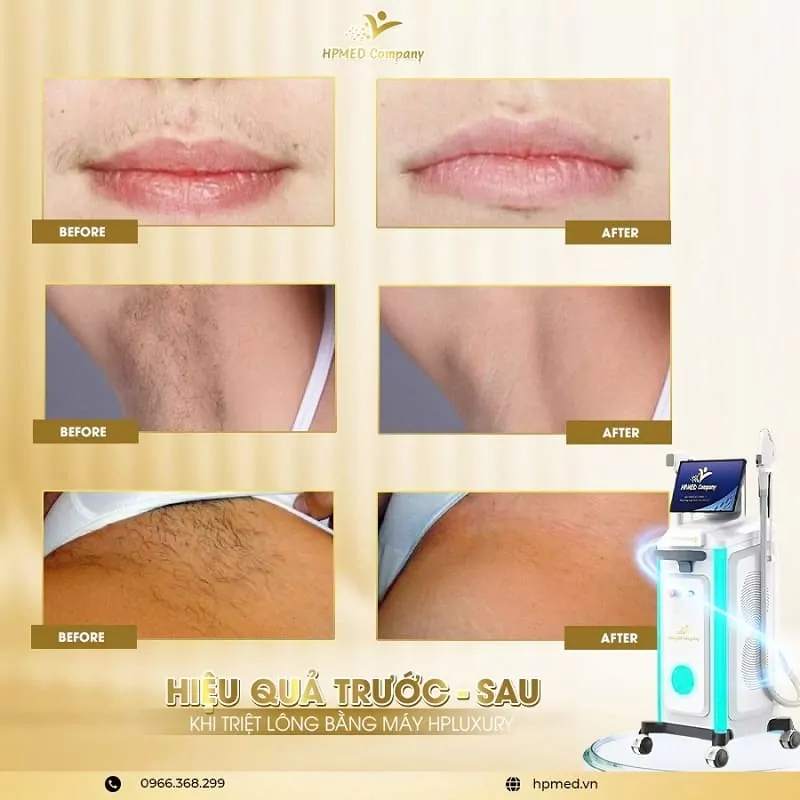 Máy Triệt Lông Diode Laser Cao Cấp