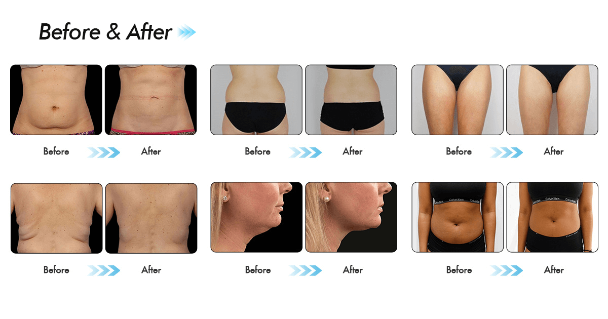 Máy Giảm Béo Quang Đông 360 CRYOLIPOLYSIS | Cao Cấp Bắc Kinh