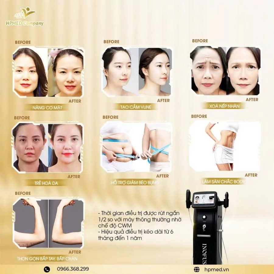 Máy Hifu INOFUS Nâng Cơ Trẻ Hóa | Cao Cấp Hàn Quốc