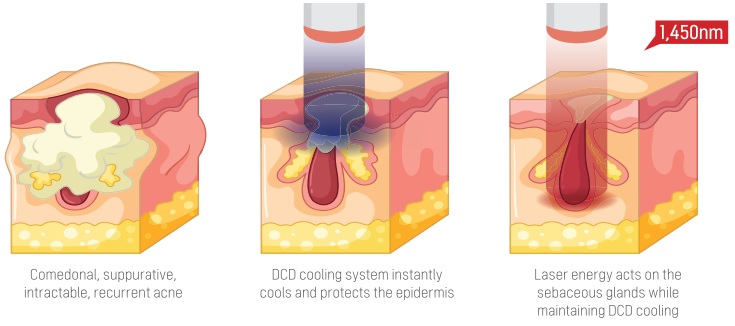 nguyên lý hoạt động của Máy Laser 1450nm