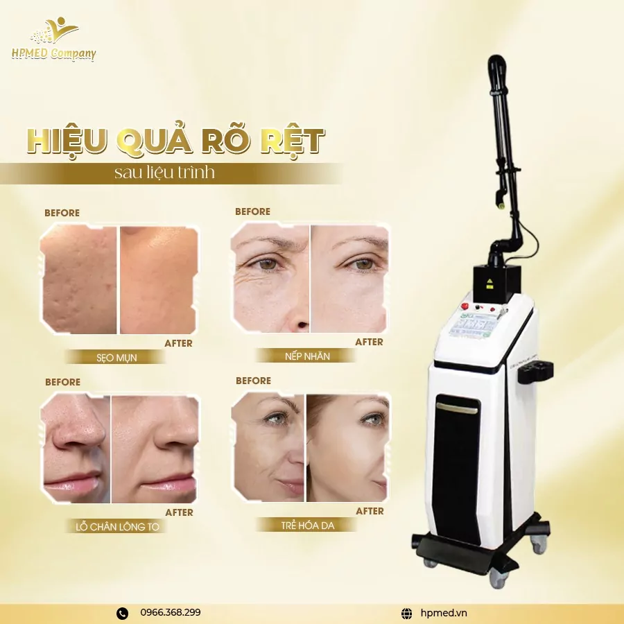 Máy Laser CO2 Fractional Pentagon Glass F Bóng Thủy Tinh Hàn Quốc ⭐ Ultra Pulse 20W – Chuẩn Điều Trị Sẹo &amp; Trẻ Hóa Da