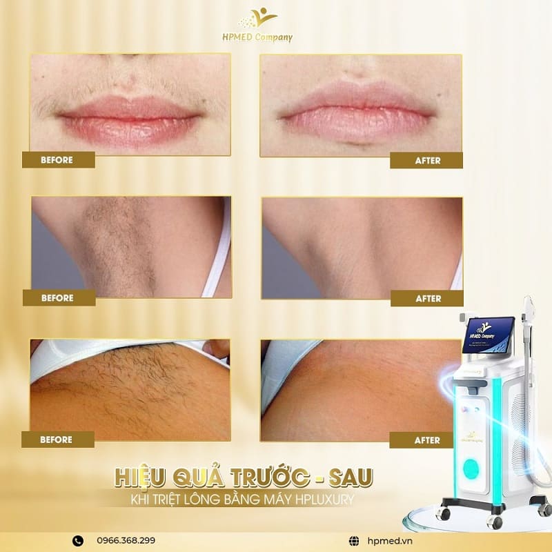 Hiệu quả triệt lông bằng máy HPMED HPLuxury với hình ảnh so sánh trước và sau trên môi, nách, vùng bikini