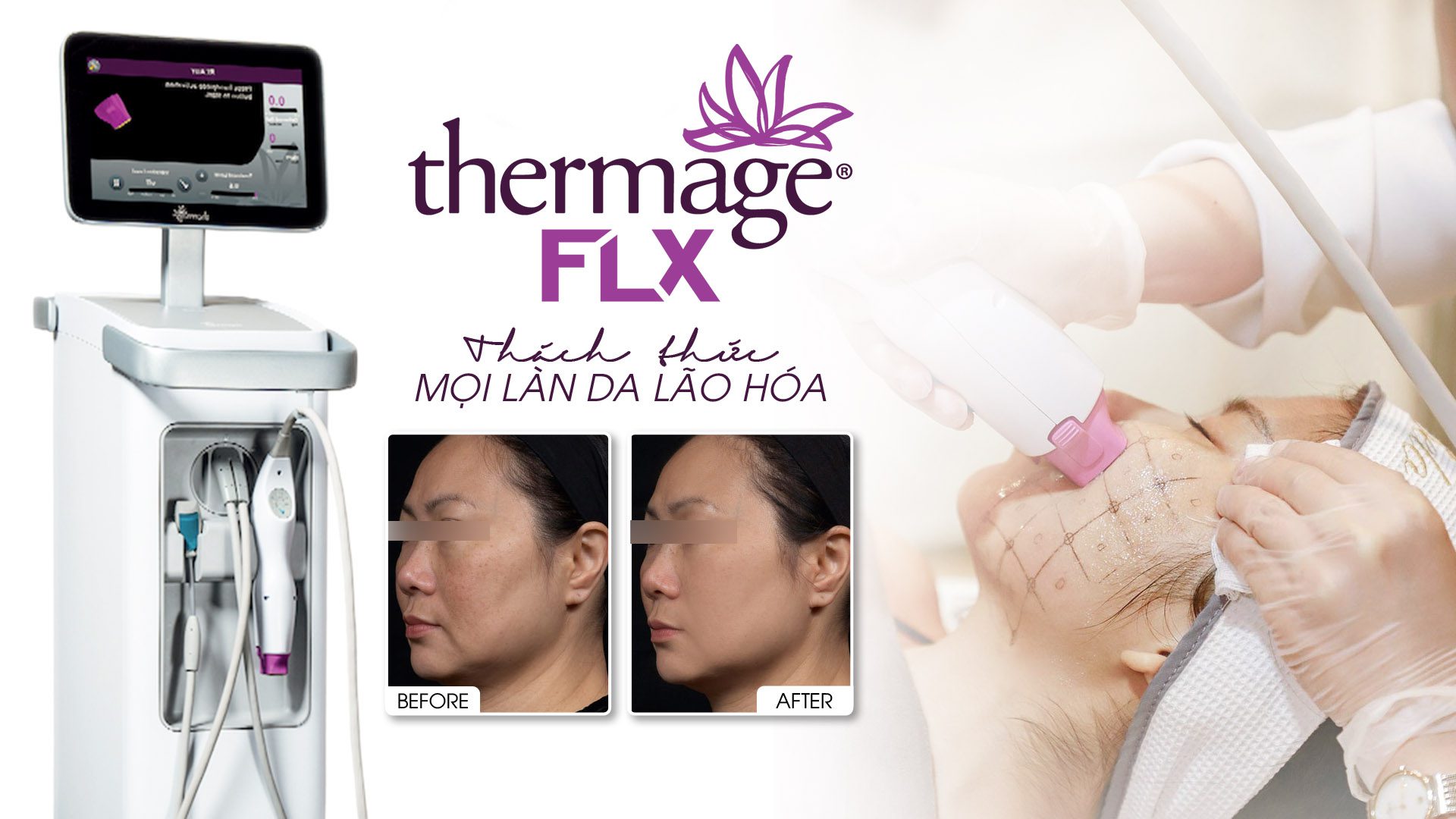 Dịch Vụ Sửa Chữa Thermage FLX Chuyên Nghiệp, Chi Phí Cạnh Tranh